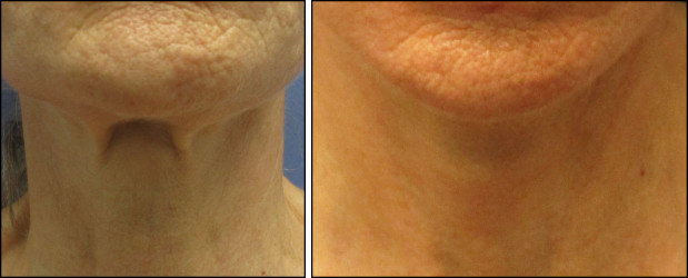 facelift